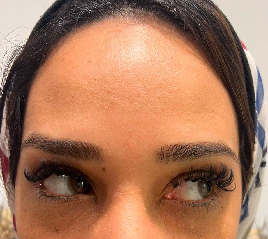 Botox After 1