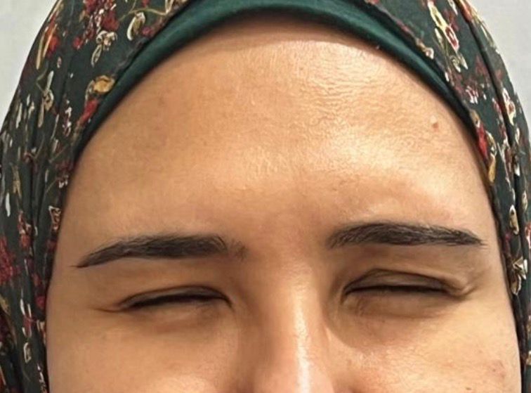 Botox After 3