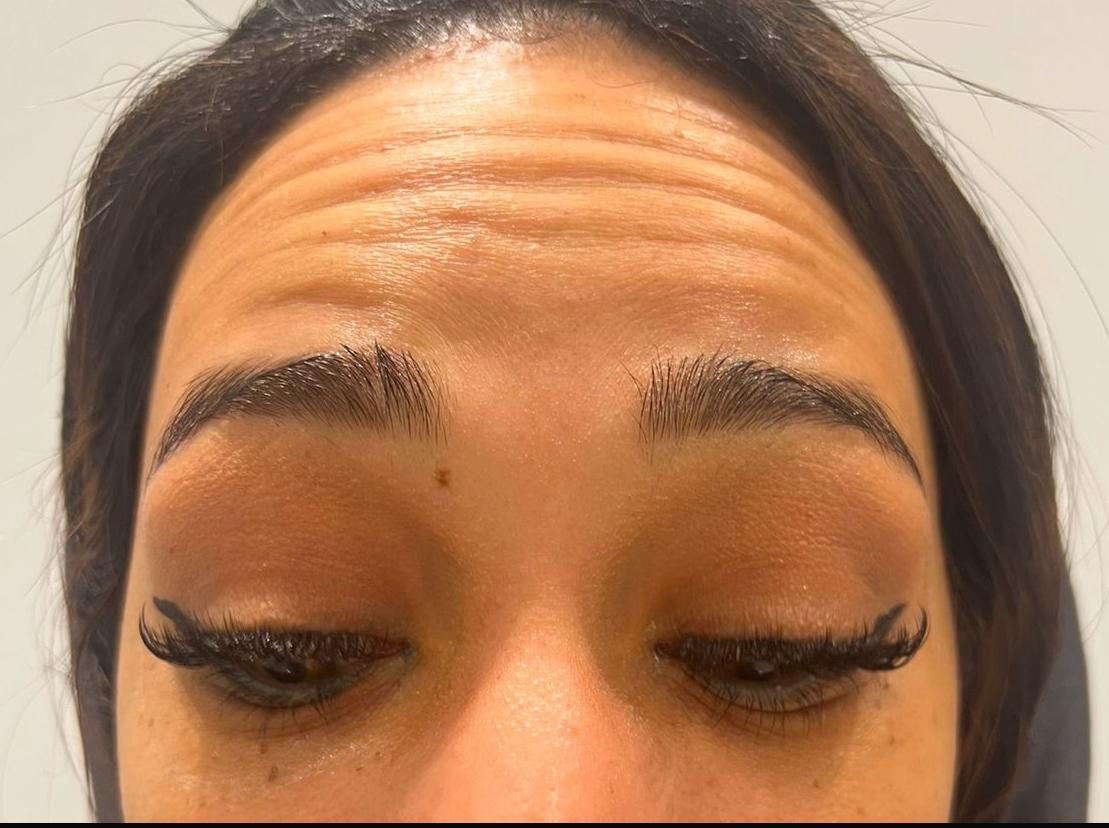 Botox Before 1